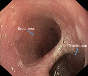 Esophageal diverticulum: Anatomy, Causes, Significance