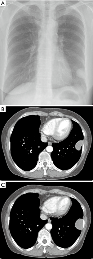 small cell lung cancer spread to the brain