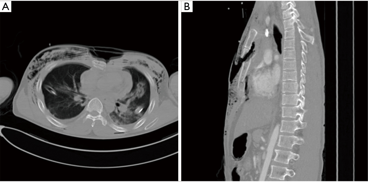 Nuss procedure for surgical stabilization of flail chest with