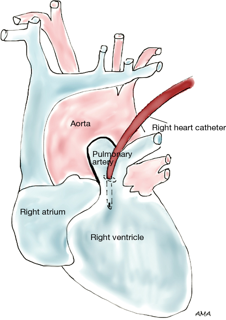 Surgery for lung cancer invading the mediastinum - Al-Ayoubi - Journal