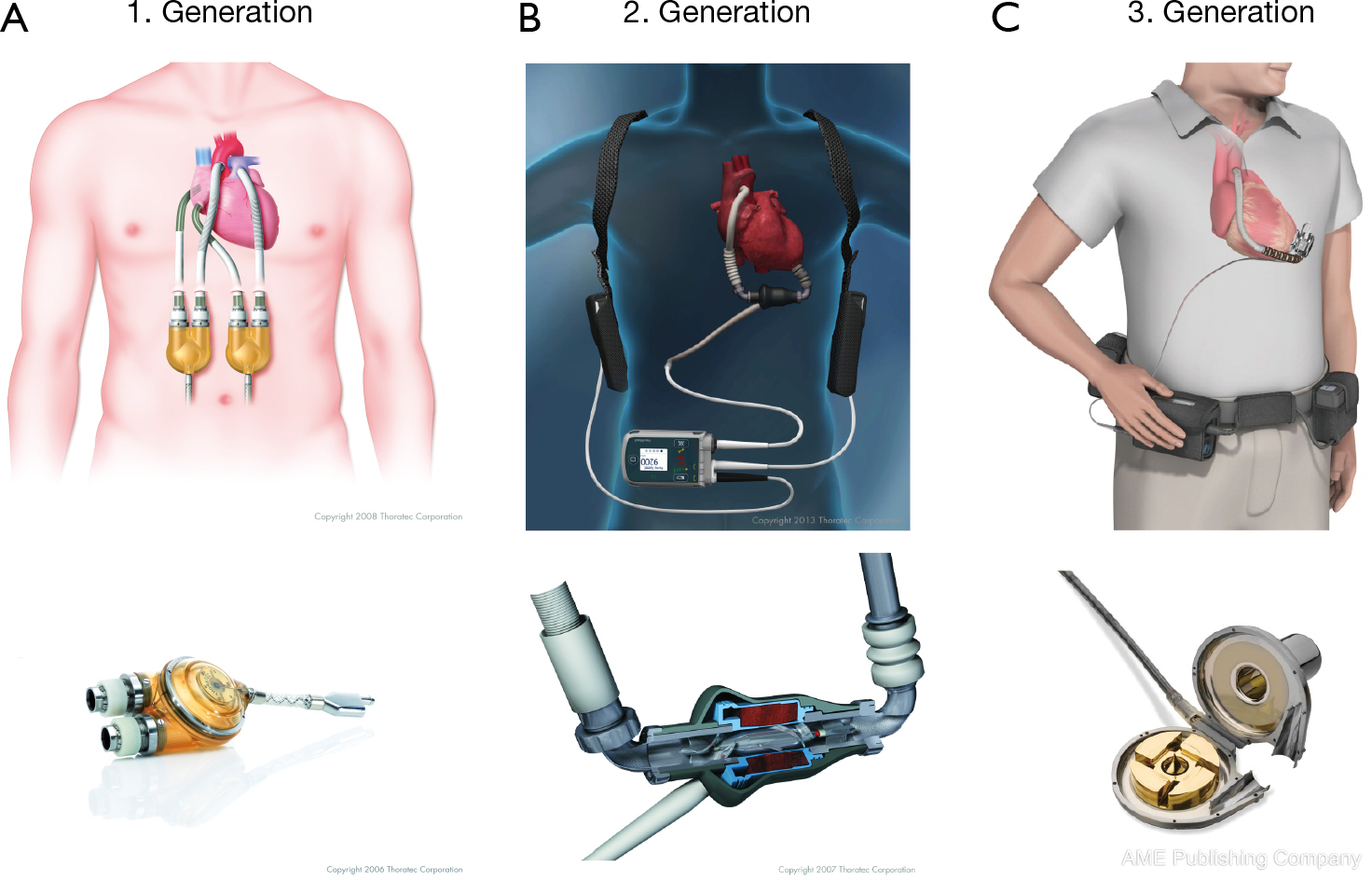Left ventricular assist devices—current state and perspectives