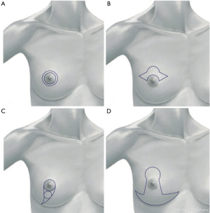 The modern concept of breast conserving surgery - Natale
