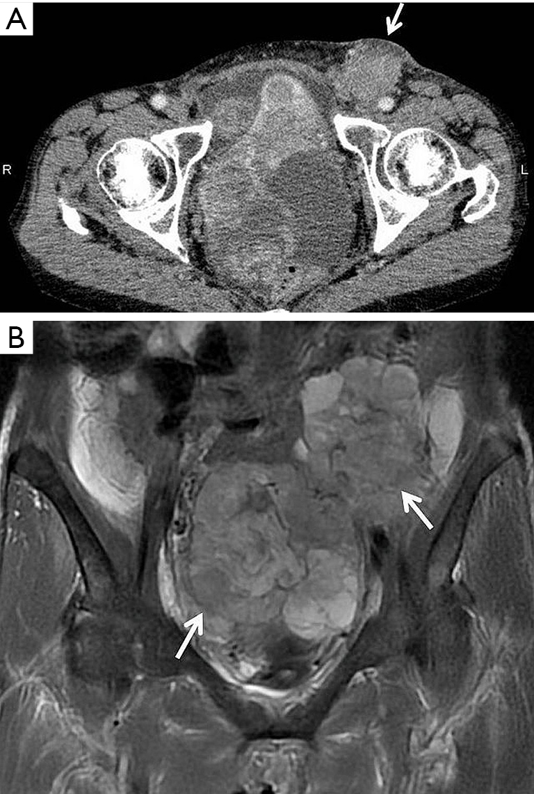 Radiation Therapy For Superficial Inguinal Lymph Node Metastases From Ovarian Clear Cell Carcinoma And Associated Inguinal Hernia Ishibashi Translational Cancer Research