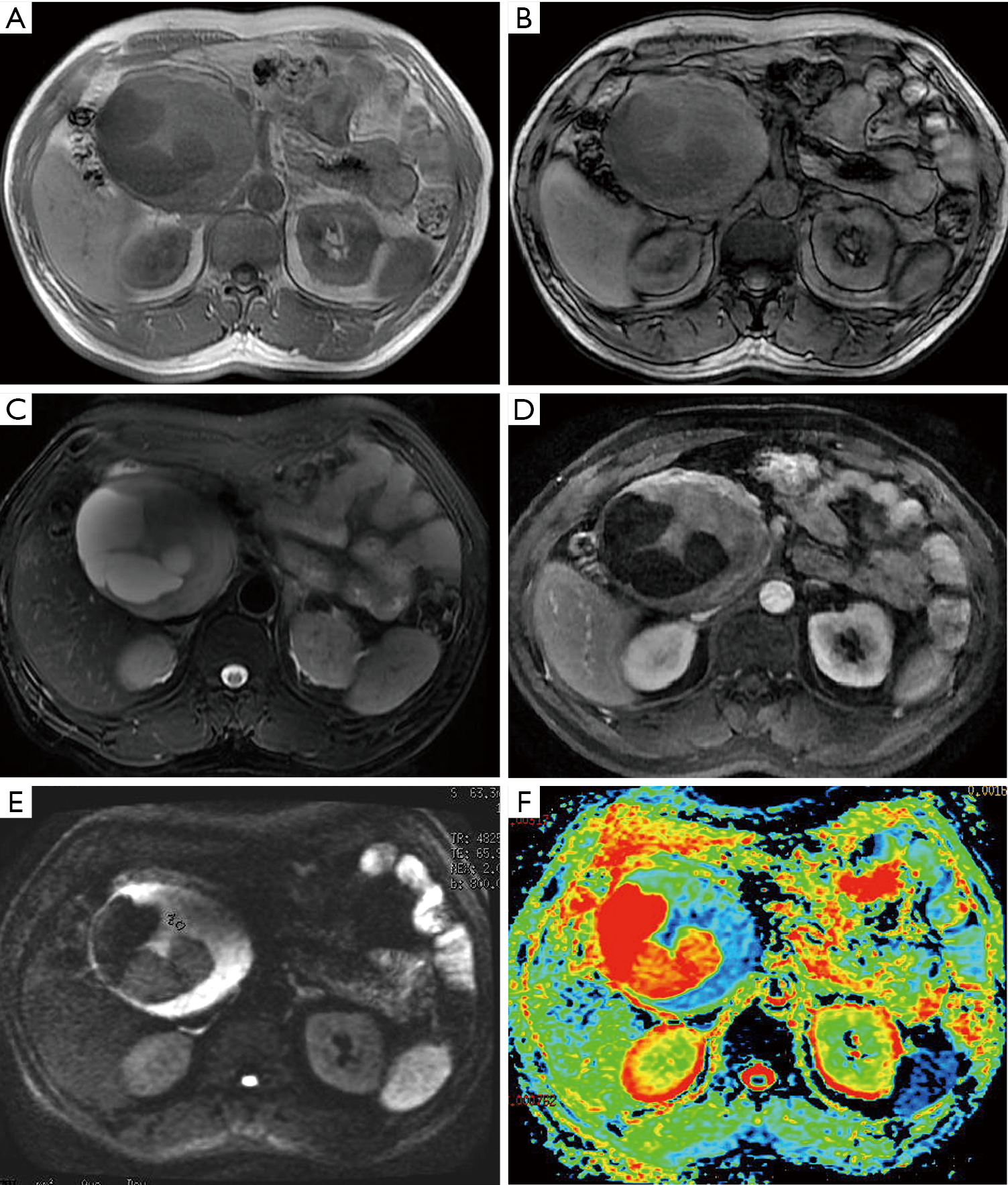 Value Of 3 0t Magnetic Resonance Imaging In The Diagnosis Of Retroperitoneal Tumors Zhu Translational Cancer Research