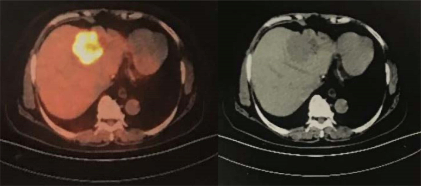 A case report of small bowel adenocarcinoma with liver 