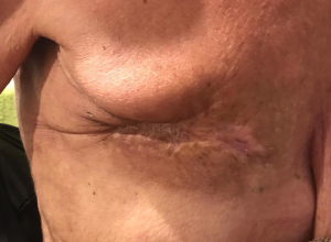 Post-operative image. Right breast 30 days after electrochemotherapy.