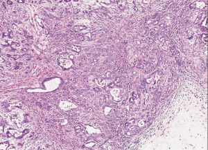 Pathology of pancreatic tumors - Sanchez - Translational