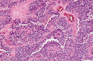 Pathology of pancreatic tumors - Sanchez - Translational