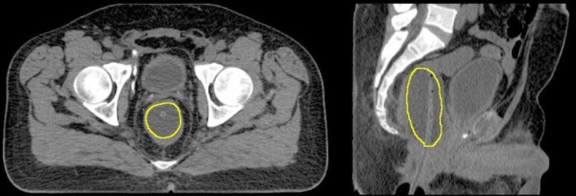 Emerging Evidence For The Role Of An Endorectal Balloon In Prostate Radiation Therapy Both Translational Cancer Research