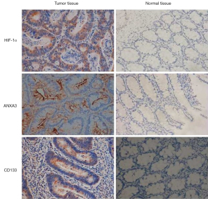 半額満載！スーパーSALE グランドセール！ ANXA3, HIF-1α, of Expression CD133 associations their and Tシャツ(半袖/袖なし)