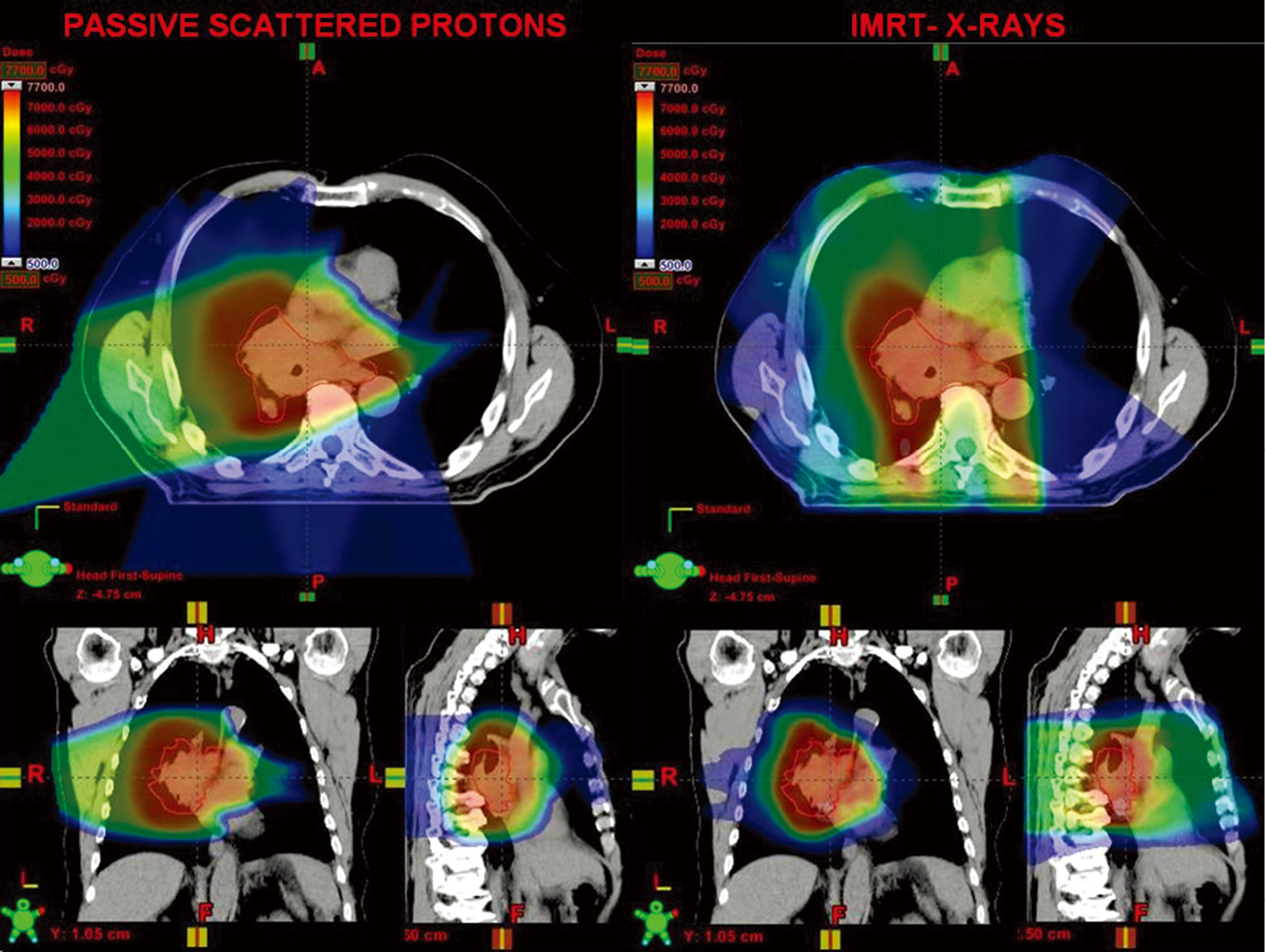 Proton Radiotherapy In The Treatment Of Lung Cancer Skinner Translational Cancer Research