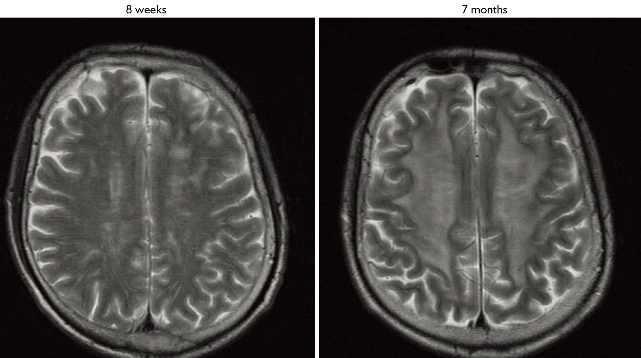 Potential Toxicities Of Prophylactic Cranial Irradiation Giordano Translational Lung Cancer Research