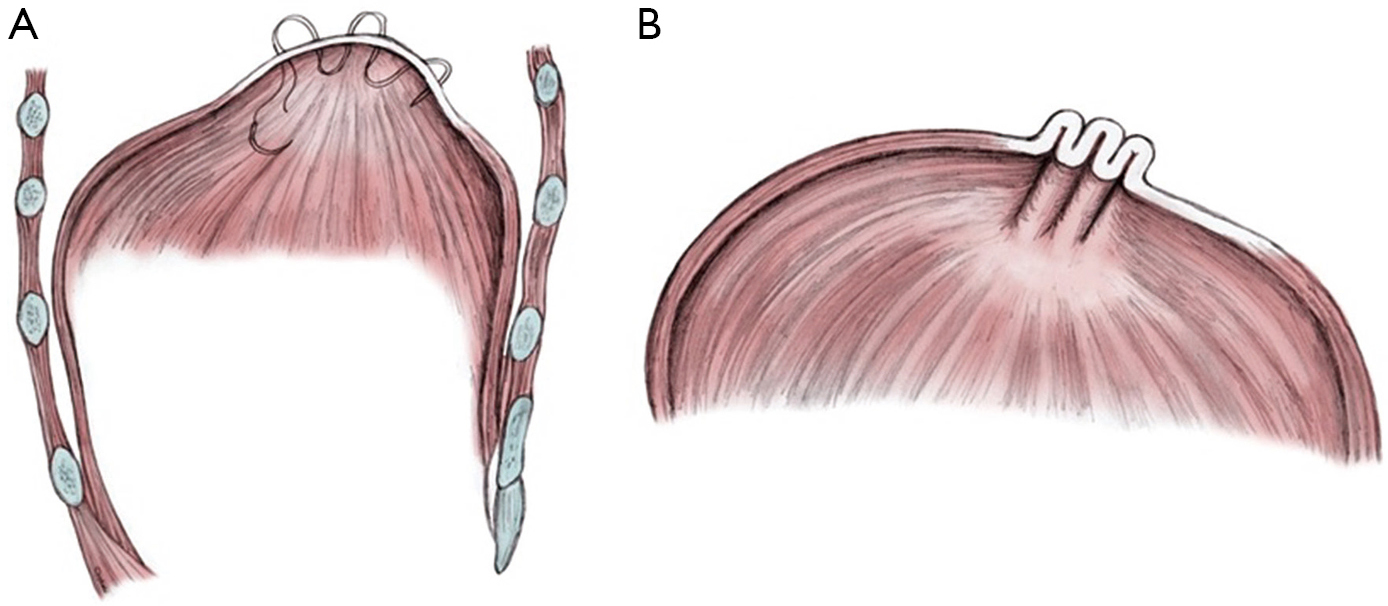 Diaphragmatic Plication For Eventration Or Paralysis Patrini Shanghai Chest