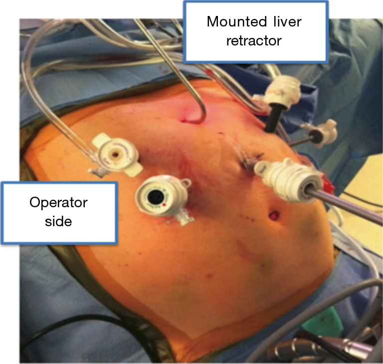Minimally Invasive Esophagectomy The Current State Of Affairs Nobel Shanghai Chest
