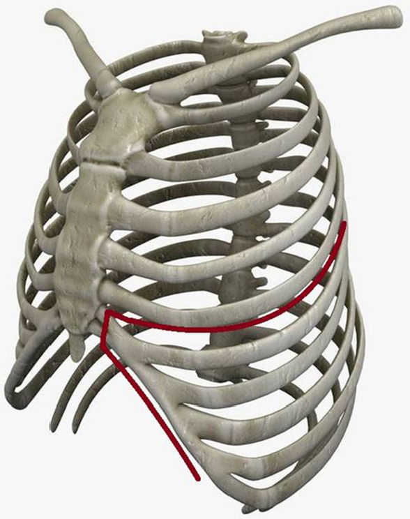 Surgical approaches for extrapleural pneumonectomy for mesothelioma: the lower door thoracotomy - Kawamukai - Shanghai Chest Surgical approaches for extrapleural pneumonectomy for mesothelioma: the lower door thoracotomy - Kawamukai - Shanghai Chest