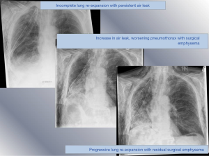Choice Khullar Leak Video - Postoperative subcutaneous emphysema: prevention and treatment - Lodhia -  Shanghai Chest