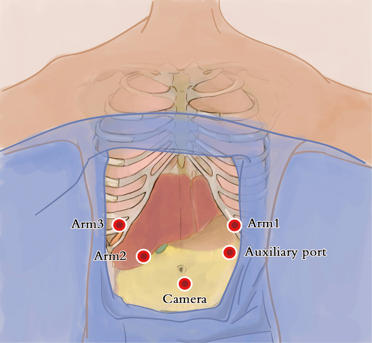Robotic Assisted Mckeown Esophagectomy Han Ame Medical Journal