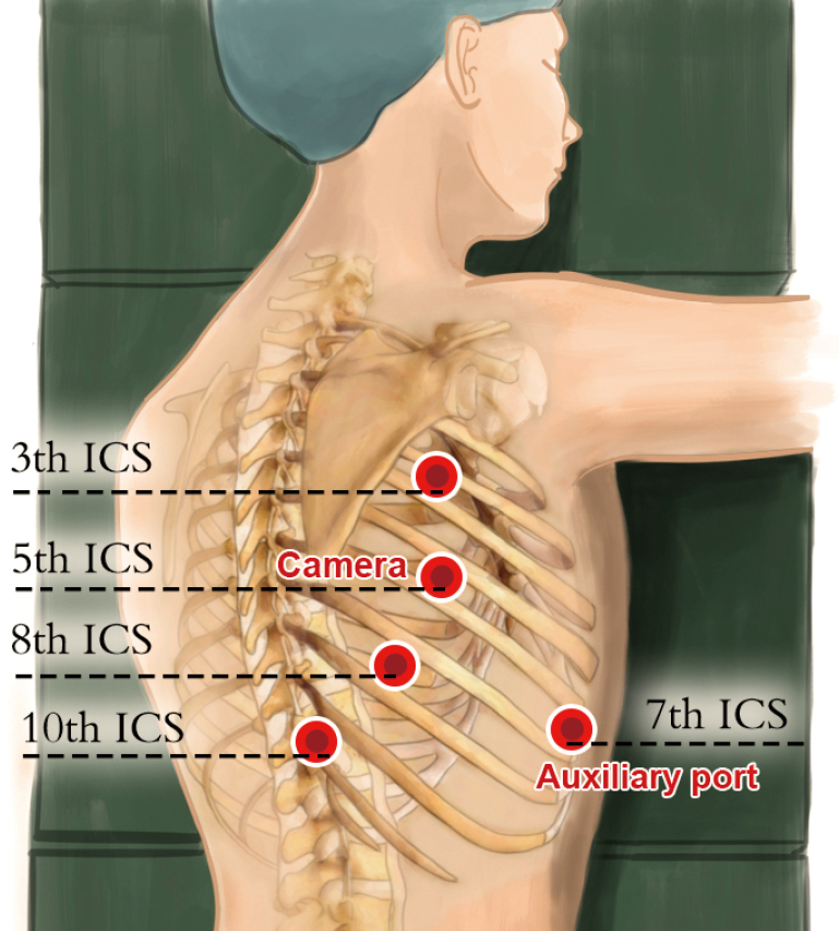 Mckeown Procedure - Plastic Surgery Procedures Richmond | Cosmetic Medical Spa ... _ Regardless of the surgical technique used, esophagectomy continues to carry risk for severe complications.