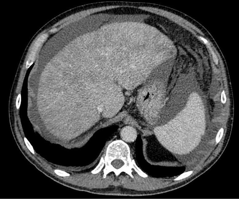 Budd Chiari Syndrome Presenting With Hepatic Transient Mosaic Enhancement Pattern And Treated With Early Transjugular Intrahepatic Portosystemic Shunt Mancuso Ame Medical Journal