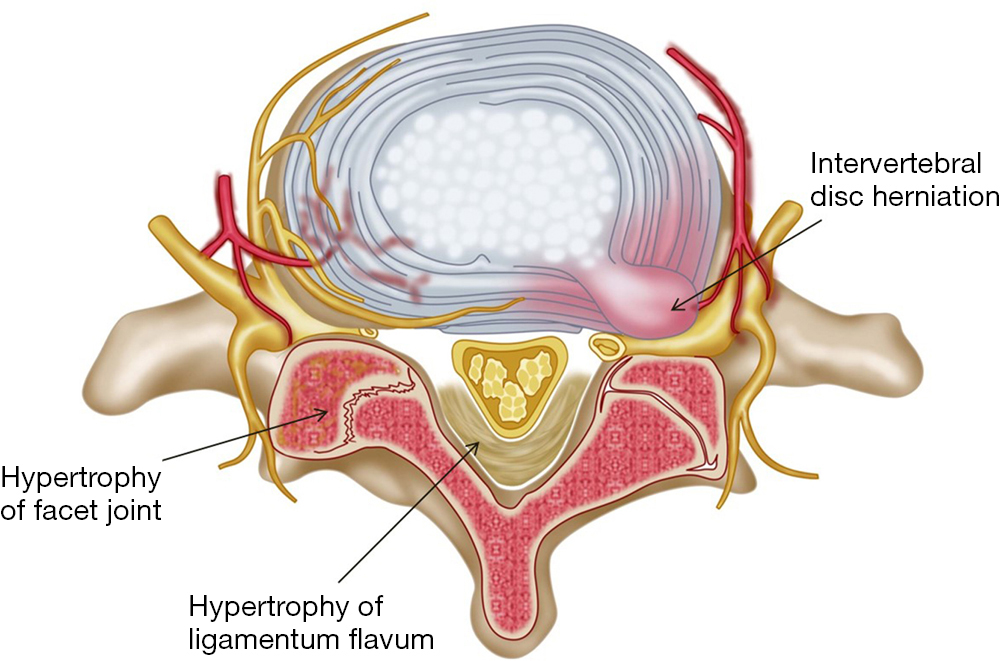 Lumbar Spinal Stenosis An Update On The Epidemiology Diagnosis And Treatment Wu Ame Medical Journal