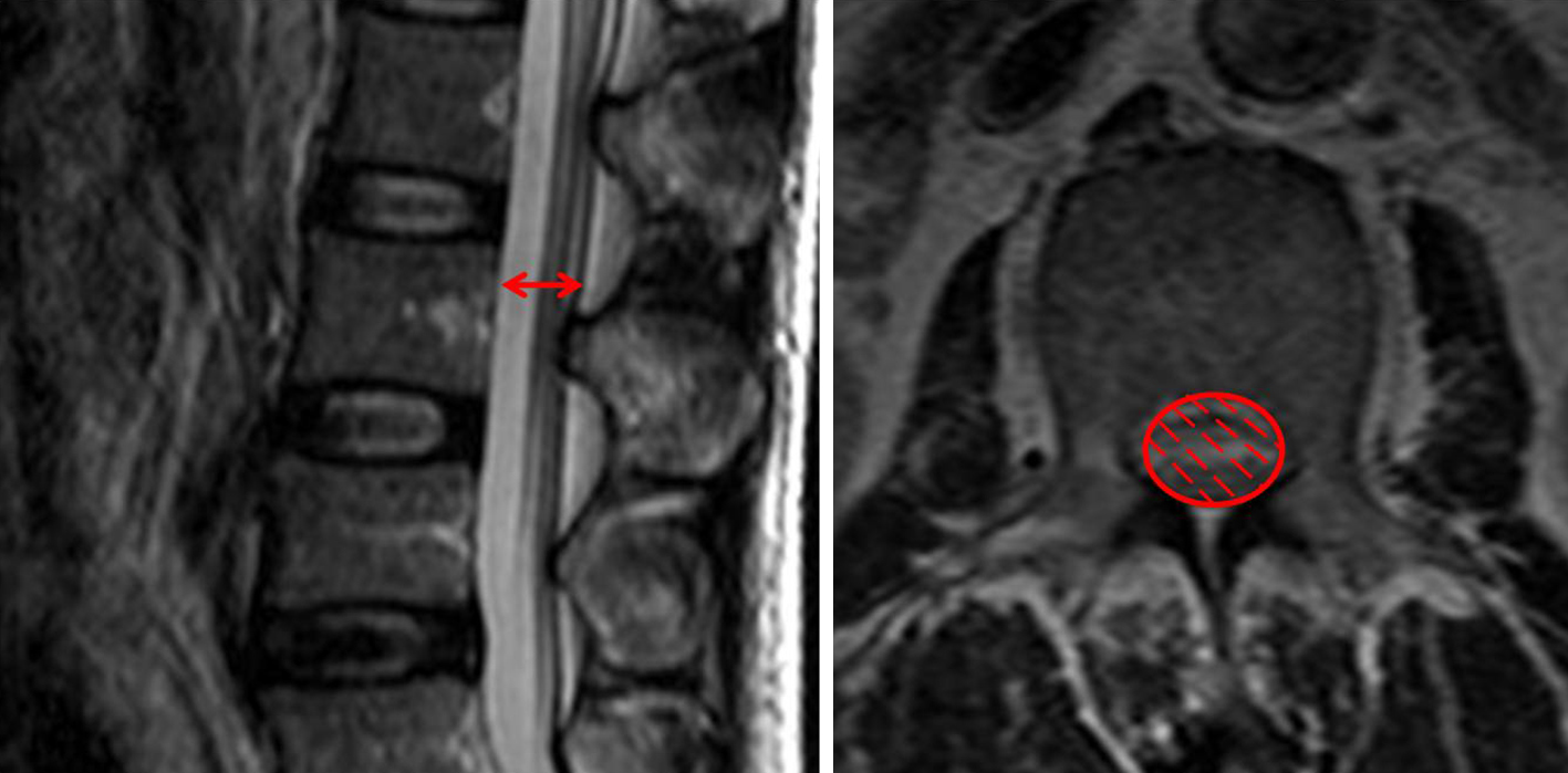 Lumbar Spinal Stenosis An Update On The Epidemiology Diagnosis And Treatment Wu Ame Medical Journal