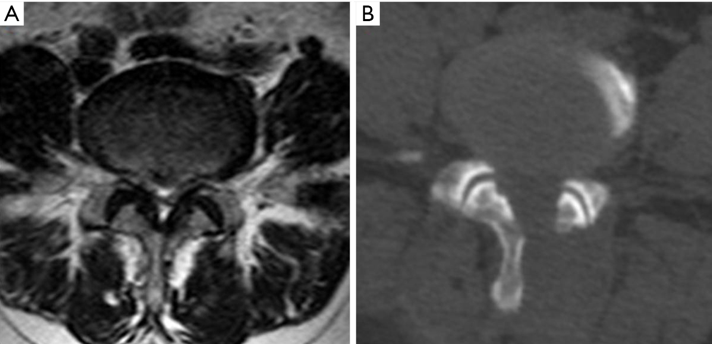 Lumbar Spinal Stenosis An Update On The Epidemiology Diagnosis And Treatment Wu Ame Medical Journal