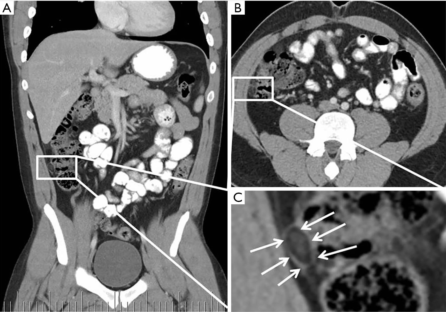 Know the name: acute epiploic appendagitis—CT findings and review of literature - Patel - AME Case Reports Know the name: acute epiploic appendagitis—CT findings and review of literature - Patel - AME Case Reports