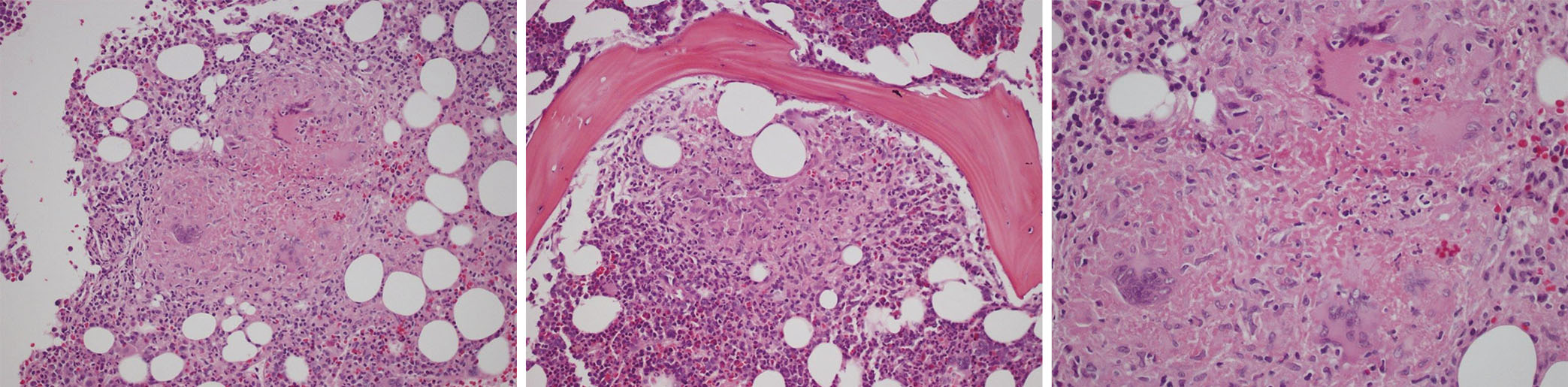 Hiding In The Bone A Case Of Miliary Tuberculosis With Bone Marrow Involvement Tahir Ame Case Reports