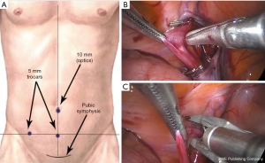 Laparoscopic right varicocelectomy for chronic scrotal pain - Chondros -  AME Case Reports