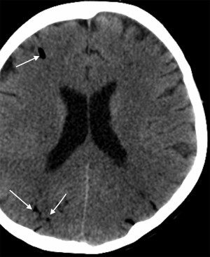 Cerebral air embolism after flushing a radial arterial line: a case report