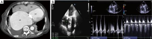 An extremely enlarged heart from a mitral valve stenosis patient 