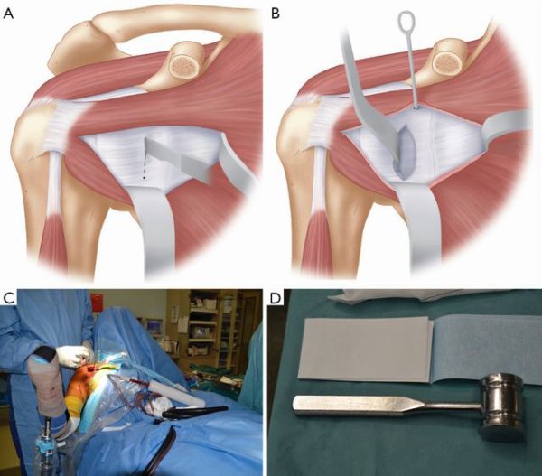 开放latarjet术式:尝试,验证及真知