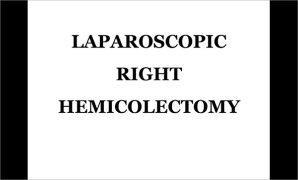 Laparoscopic right hemicolectomy: how I do it